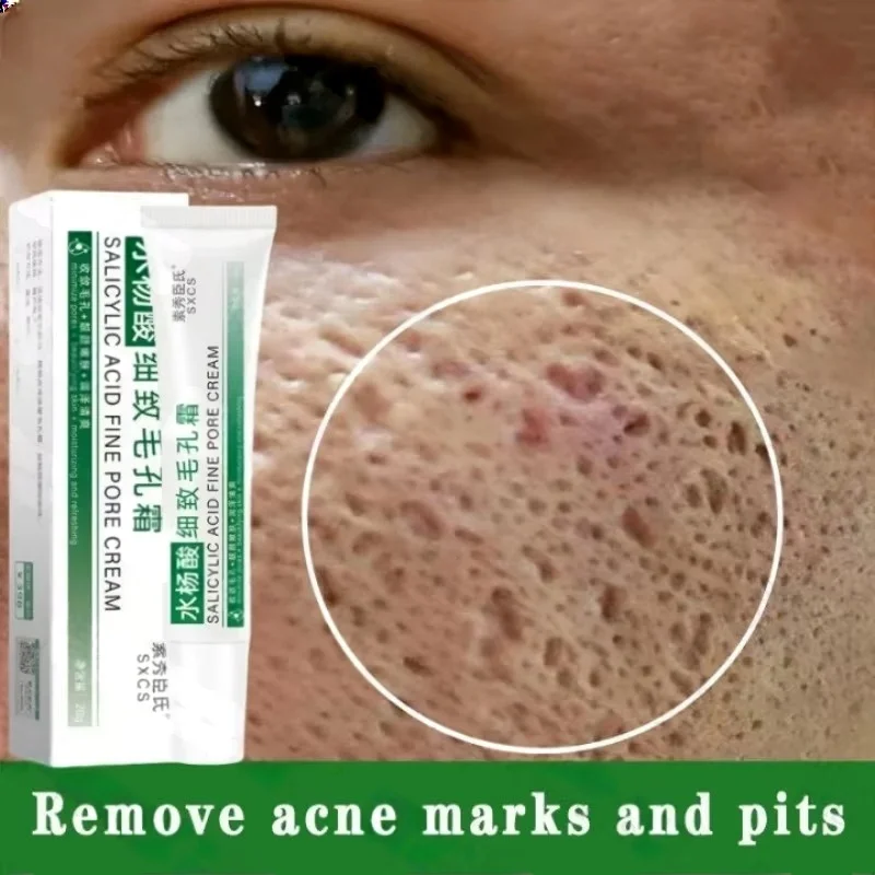 Salicylic Acid Blackhead Remover - Salicylic Acid Pore Clearing Cream Shrink