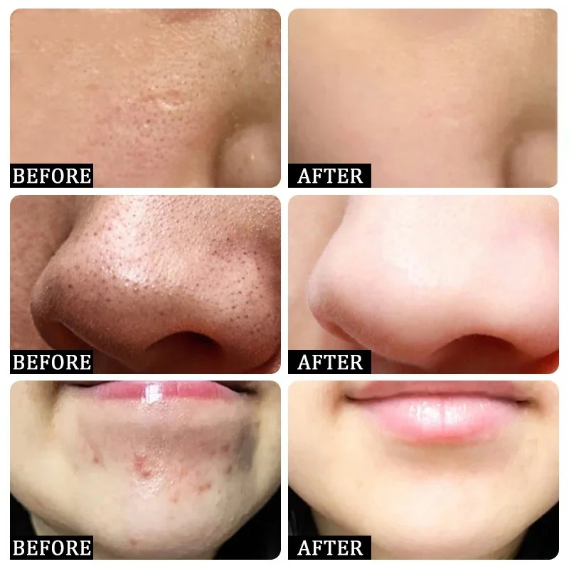 Salicylic Acid Pore Clearing C - огляд і ціна Salicylic Acid Blackhead Remover