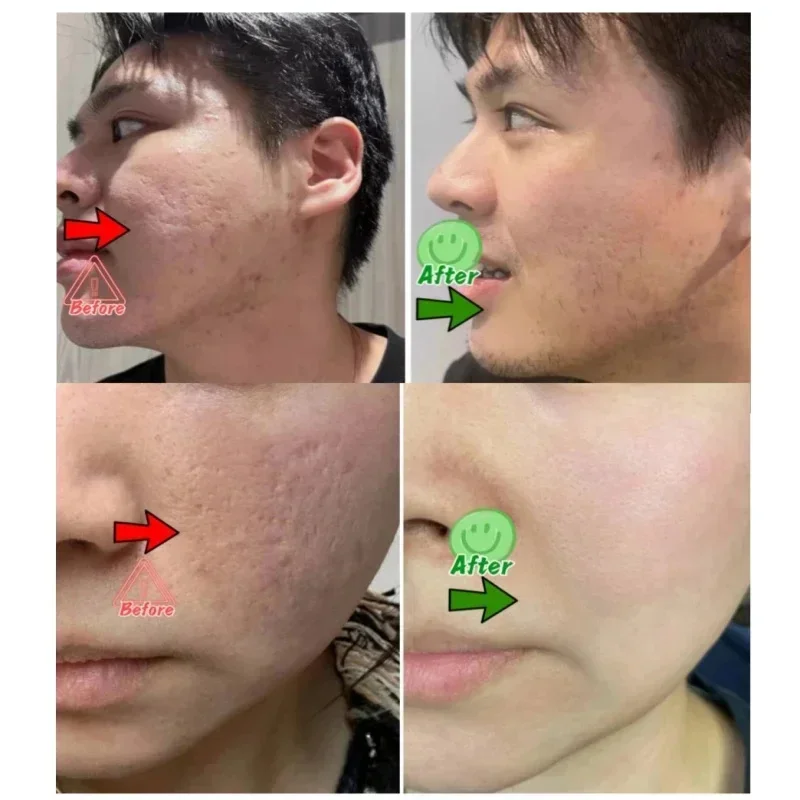 Salicylic Acid Pore Clearing C - огляд і ціна Salicylic Acid Blackhead Remover