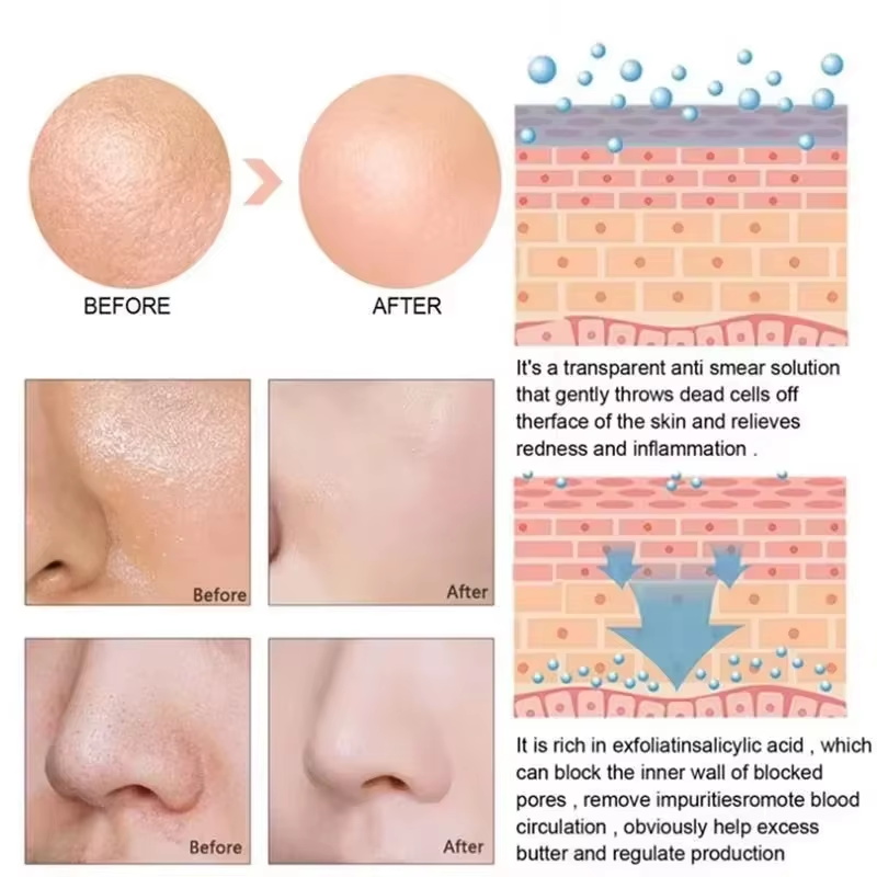Salicylic Acid Pore Shrinking  - огляд і ціна Salicylic Acid Blackhead Remover