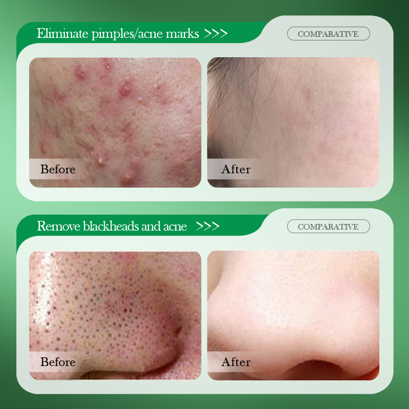 Salicylic Acid Acne Treatment  - огляд і ціна Salicylic Acid Blackhead Remover
